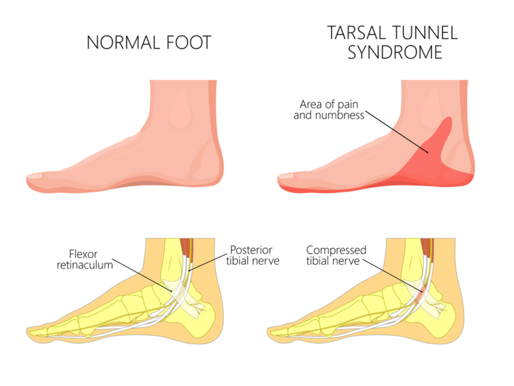 Differential diagnosis of plantar heel pain a | Download Scientific Diagram